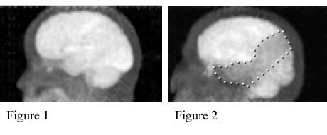 PET scans of the brain