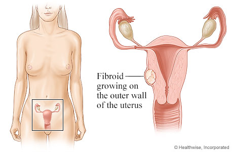 Location of uterus and ovaries, with detail of fibroid growing on outer wall of  uterus