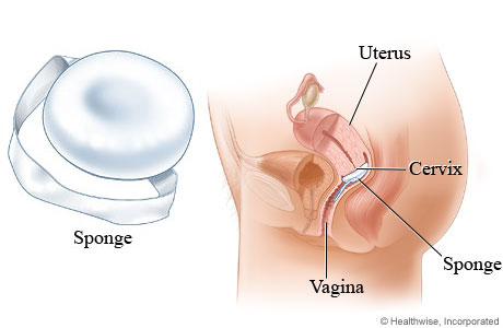 Sponge method of birth control