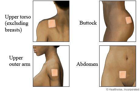 Picture of birth control patch locations