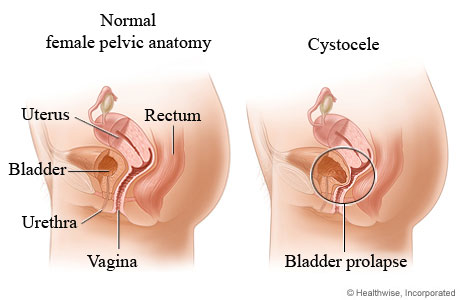 Cystocele