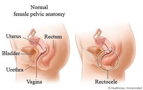 Rectocele