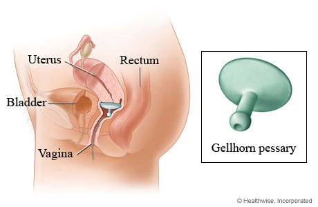 Gellhorn pessary