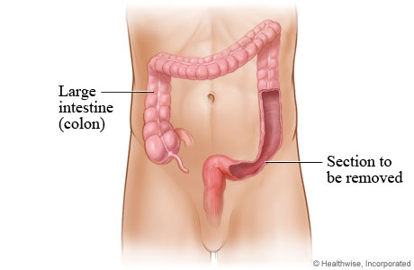 Large intestine (colon)