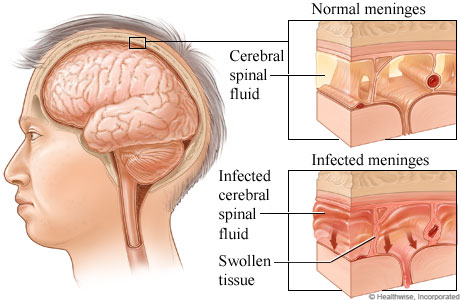 Comparison of normal meninges and infected meninges