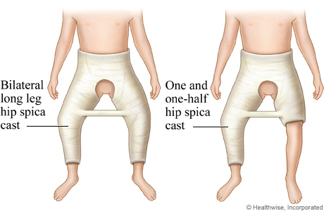 Picture of two different types of spica cast with a bar