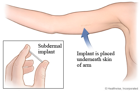 Subdermal implant for birth control