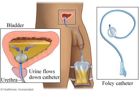  Foley catheter