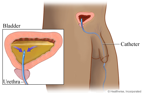 Picture of a catheter