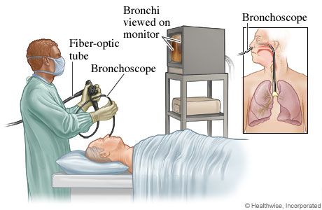 Bronchoscopy