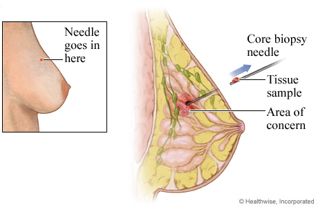 Core needle biopsy of the breast