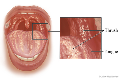 Thrush in the mouth, with close-up of thrush on  tongue and inside of cheek