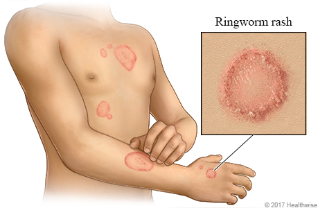 Ringworm skin rash