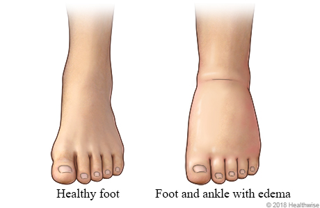 Normal foot and ankle, and foot and ankle with edema