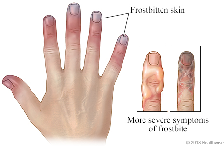 Hand with frostbitten fingers, and detail of fingers with blisters or black skin