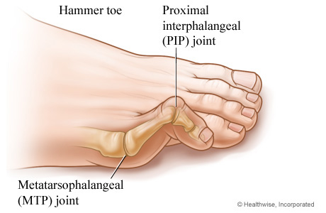 Hammer toe