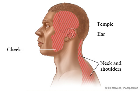 Areas where TMD pain may occur: The cheek, temple, ear, and neck and shoulders 