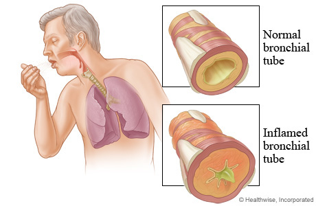 Chronic bronchitis