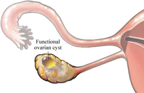 Functional ovarian cyst