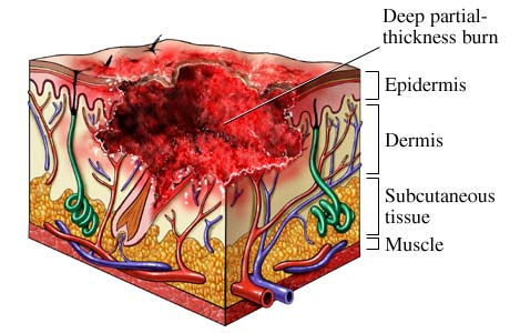 Second-degree burn: deep partial-thickness burn