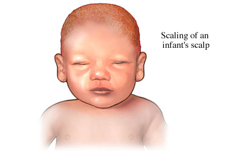 Cradle cap