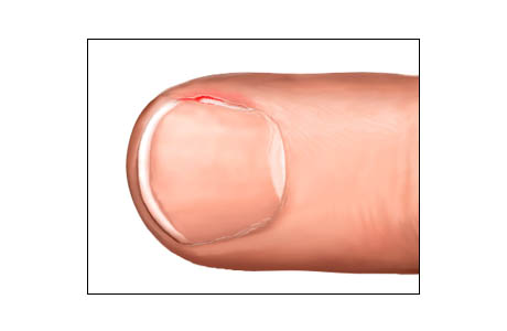 Hangnail