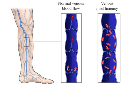 Venous insufficiency