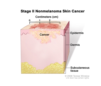 Stage II nonmelanoma skin cancer; drawing shows a tumor that is more than 2 centimeters wide that has spread from the epidermis (outer layer of the skin) into the dermis (inner layer of the skin). Also shown is the subcutaneous tissue below the dermis.