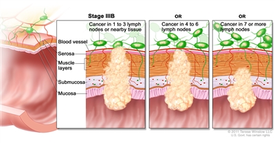 Rectal Cancer Treatment (PDQ®): Treatment - Health Professional ...