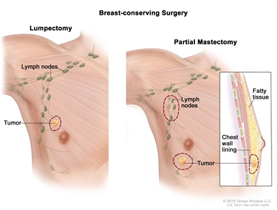 Genetics of Breast and Gynecologic Cancers (PDQ®) - NCI