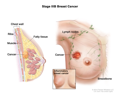 Genetics of Breast and Gynecologic Cancers (PDQ®) - PDQ Cancer
